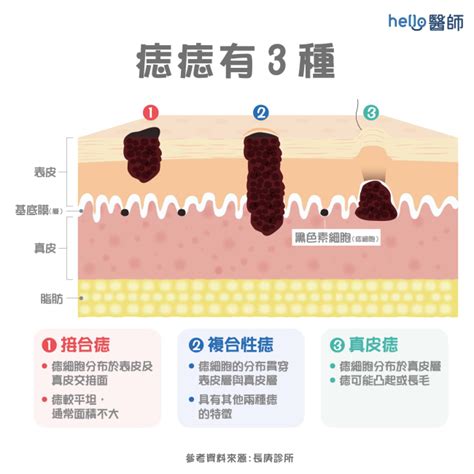 痣的形成原因|为什么会长痣？